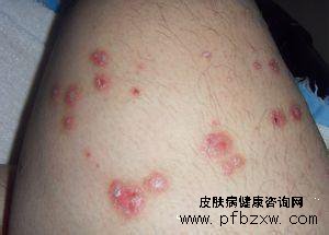 儿童牛皮癣早期症状什么样