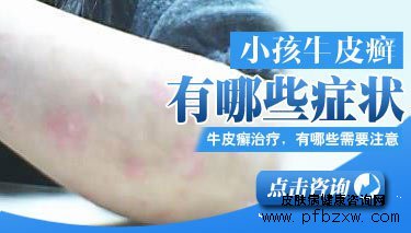 儿童牛皮癣早期症状什么样